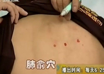 治療咳嗽的第二個穴位：肺俞穴位圖