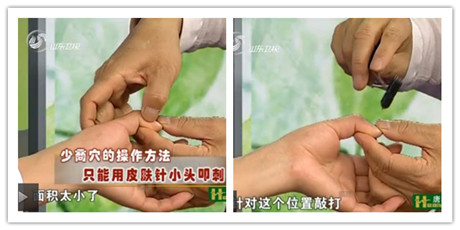 少商穴的操作方法只能用皮膚針小頭叩刺，因為它面積太小了，敲打出血來