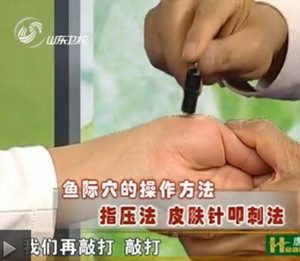  皮膚針叩刺法，敲打魚際穴，要求敲出血來。