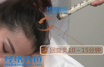 艾灸百會穴的示意圖